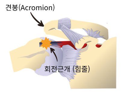 어깨 충돌증후군에서 견봉과 회전근개 힘줄이 서로 부딪히는 모습을 설명한 해부학적 일러스트